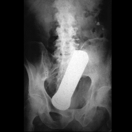 Torch in an ass x-ray