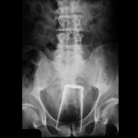 glass in ass x-ray