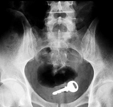 key in ass x-ray