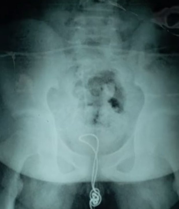 Xray of cable up his penis