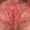 Click image for larger version. 

Name:	genital-warts-6-150x150.jpg 
Views:	118 
Size:	6.2 KB 
ID:	47121
