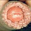 Click image for larger version. 

Name:	genital-warts-11-150x150.jpg 
Views:	91 
Size:	8.4 KB 
ID:	47122