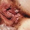 Click image for larger version. 

Name:	genital-warts-12-150x150.jpg 
Views:	89 
Size:	10.2 KB 
ID:	47123