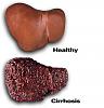 Click image for larger version. 

Name:	cirrhosis-liver.jpg 
Views:	6 
Size:	14.7 KB 
ID:	107428
